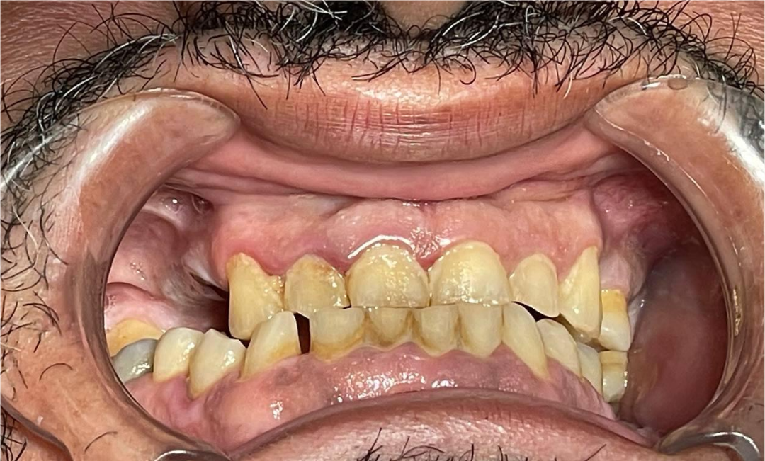 Smile Transformation 