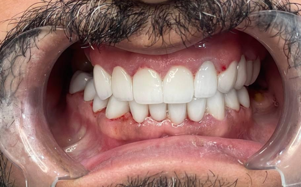 Smile Transformation 